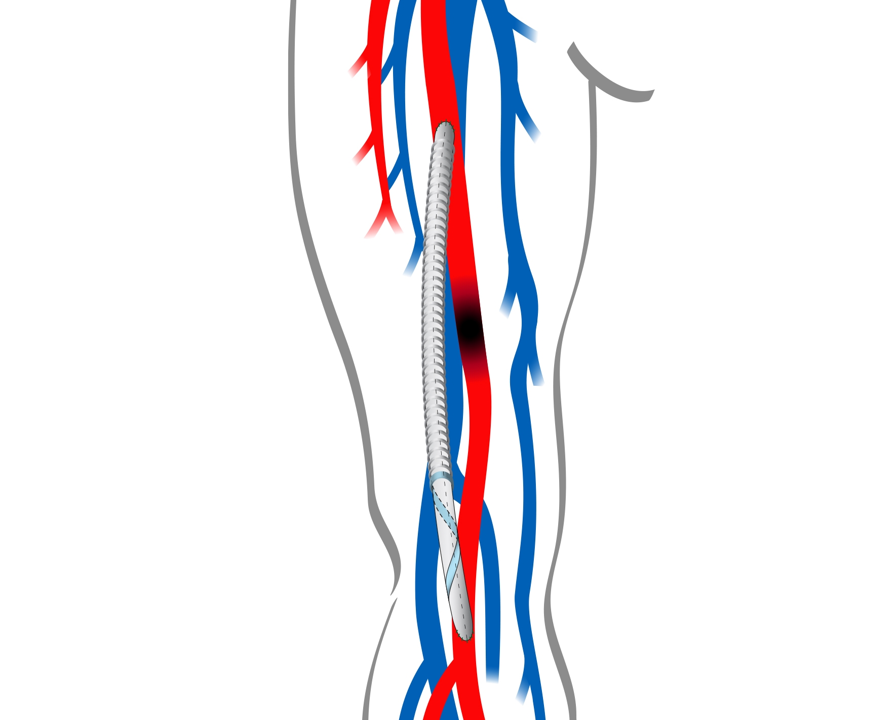 Spiral-Flow-Peripheral-graft-leg
